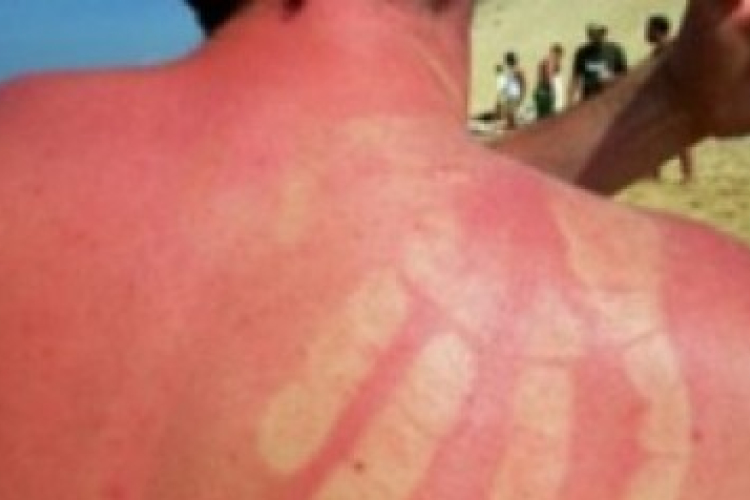 Öt rizikófaktor, ami növeli a bőrrák kockázatát