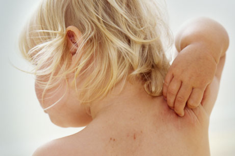 Mi az atópiás dermatitis?