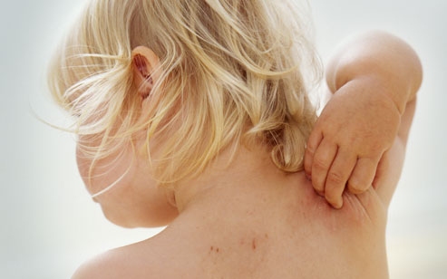 Mi az atópiás dermatitis?